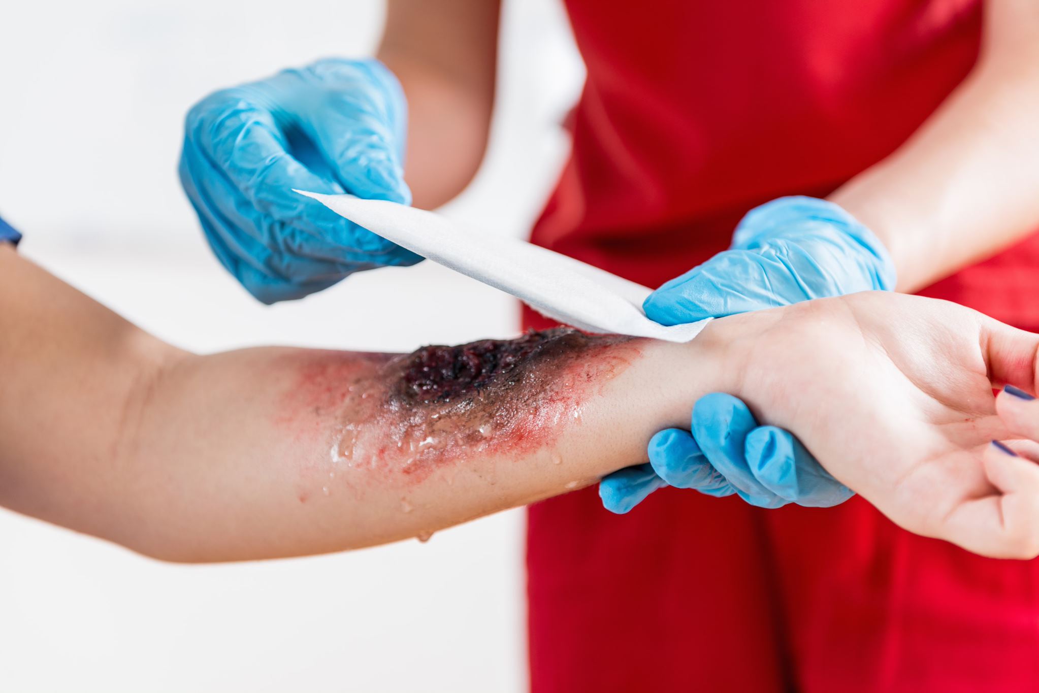 burn injuries