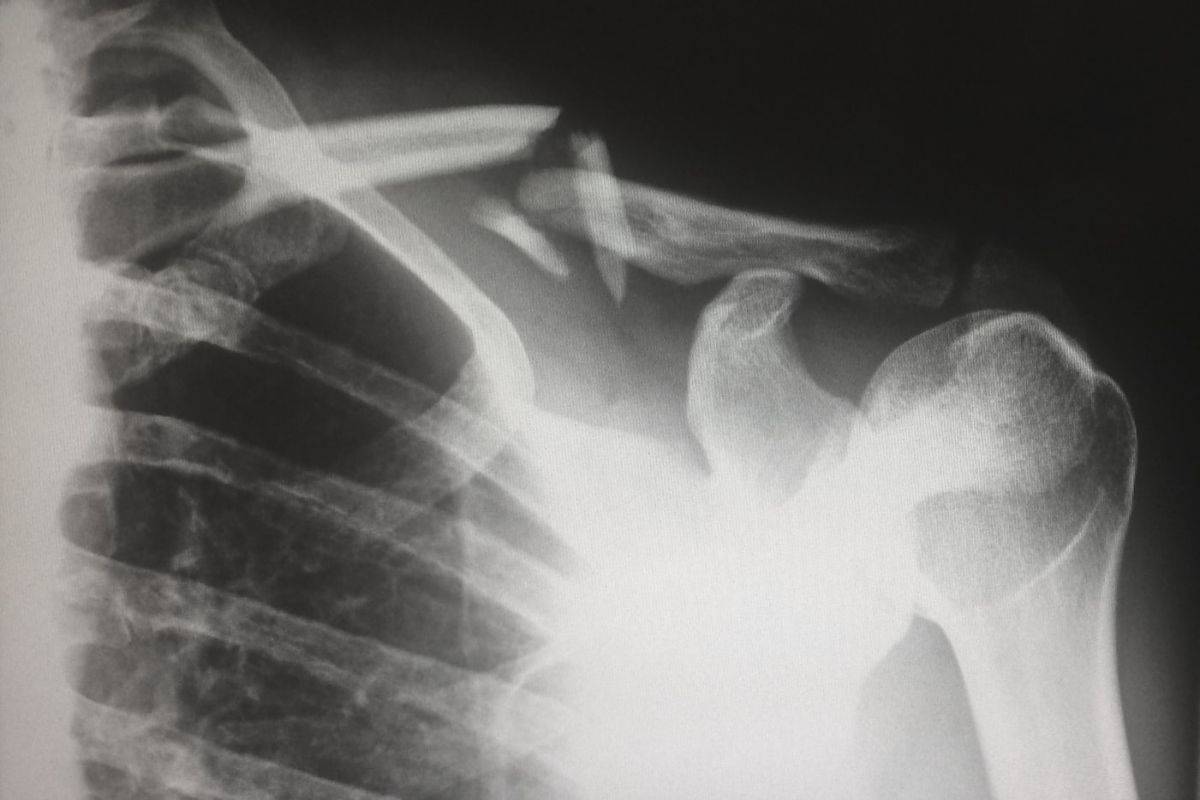 Can You Sue Someone for Falling on Their Property?
